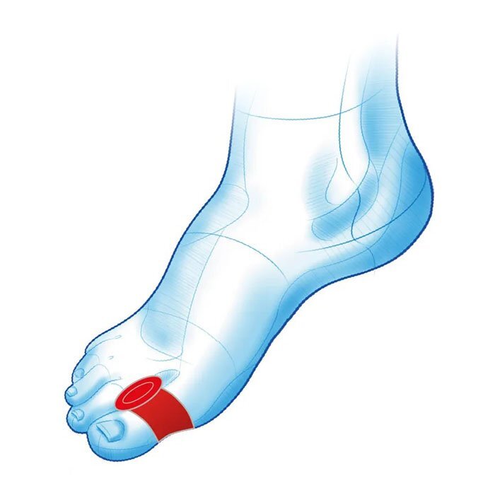 Mazbit HALUKS DUO - kliny z pierścieniami na haluksy