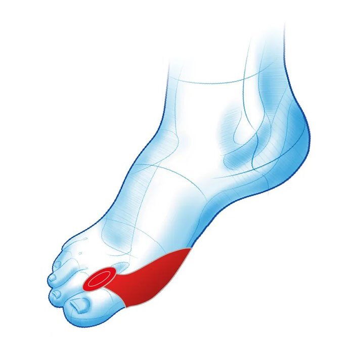 Mazbit PROHALUKS DUO - klin z osłoną na haluks