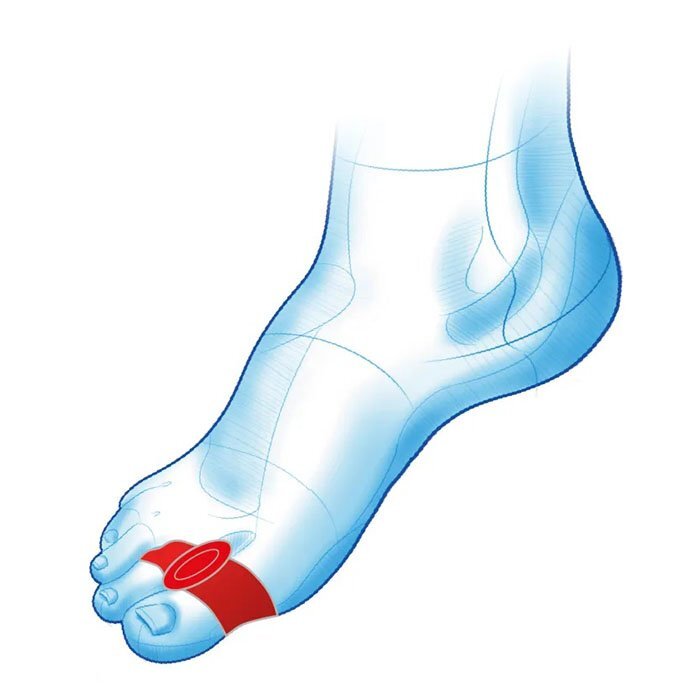 Mazbit SEPARATOR DUO - klin międzypalcowy z dwoma pierścieniami